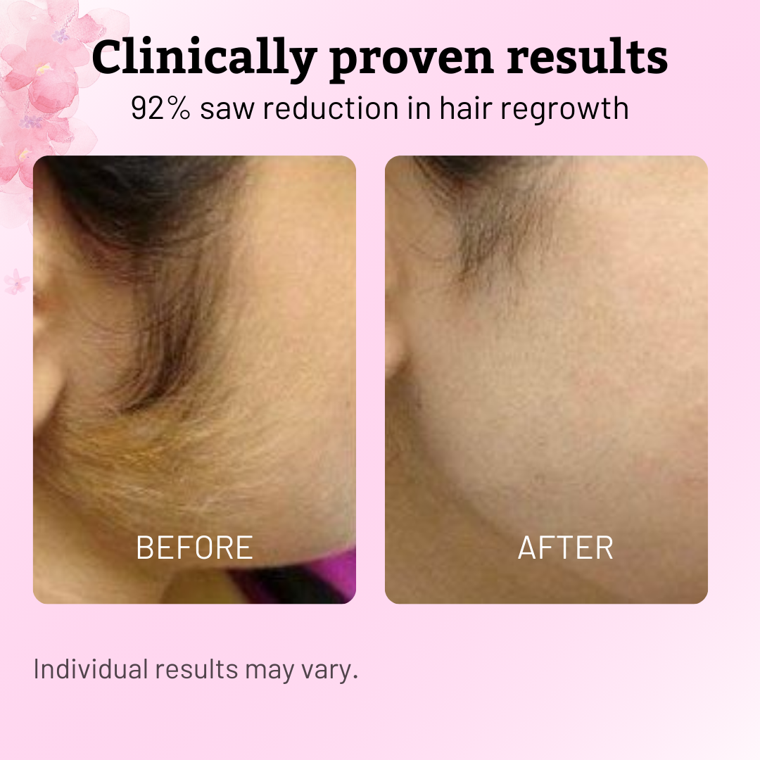 Caramela Beauty Cyperus Rotundus Oil for Natural Permanent Hair Reduction